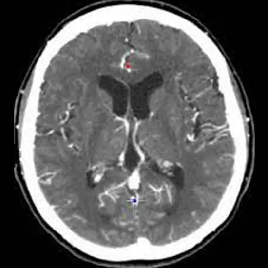 CT Head Plain and Contrast
